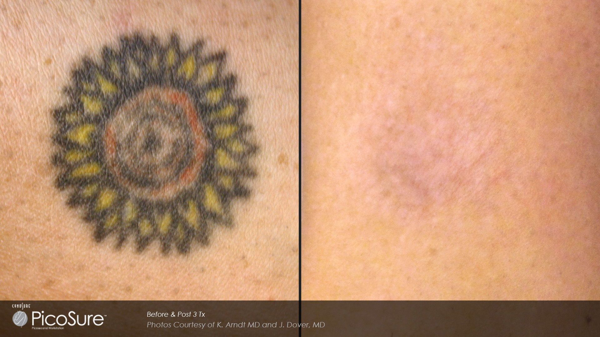 Tattoo Removal With Picosure