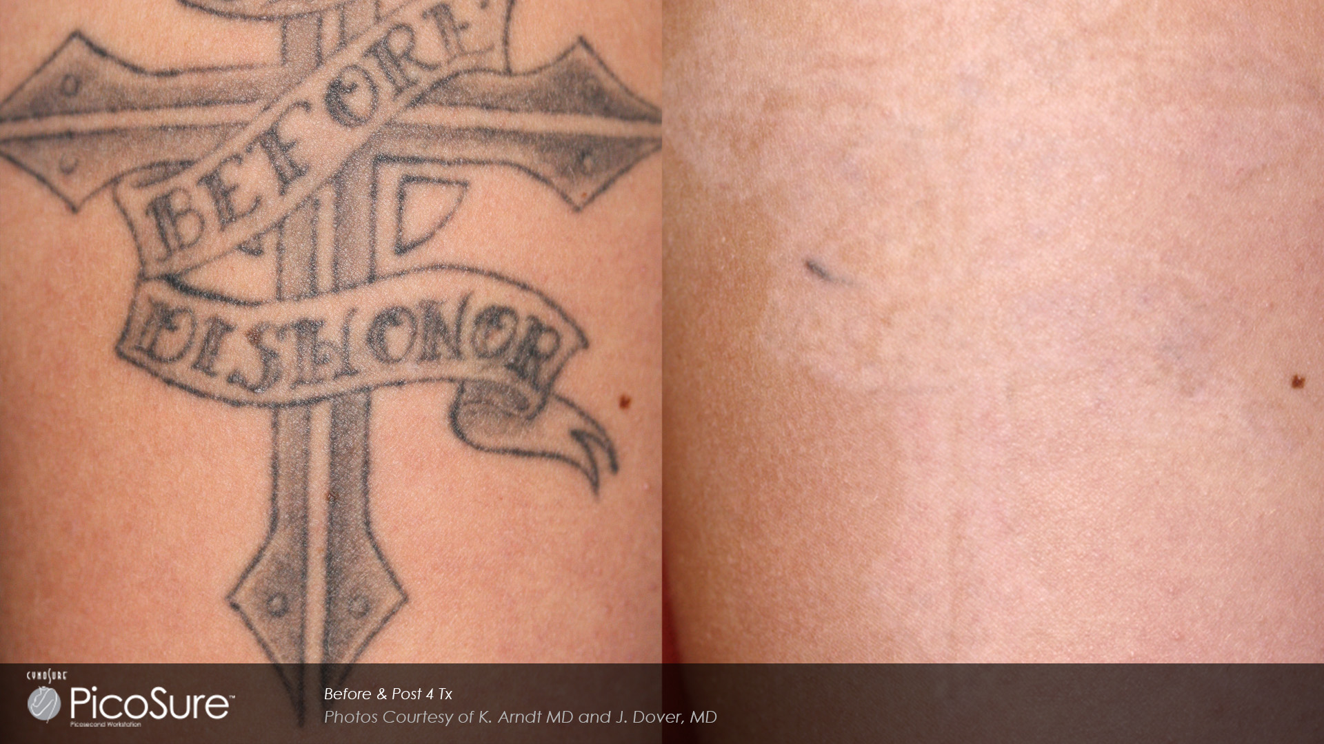 Laser Tattoo Removal Specialists Toronto - Rice Cosmetic