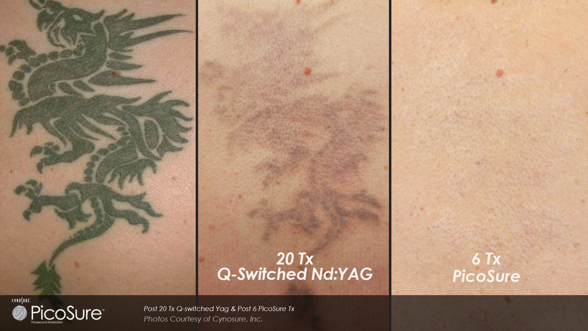 Q-Switch Versus Picosure For Tattoo Removal - Toronto, Ontario