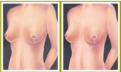 breast lift dr sean rice