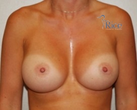 After-Breast Augmentation Round Cohesive Gel