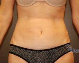 After-Liposuction