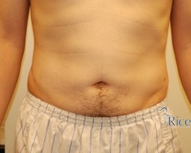 After-Liposuction