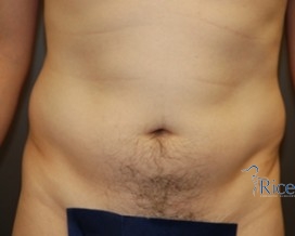 Before-Liposuction Stomach