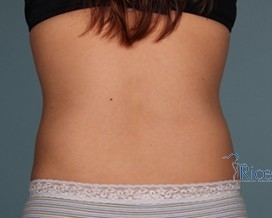 After-Liposuction