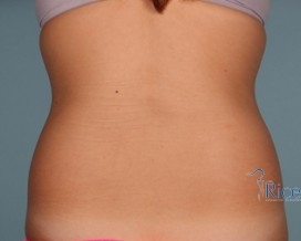 Before-Liposuction