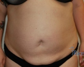 After-Liposuction