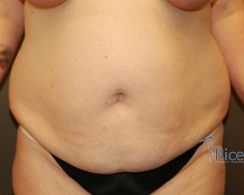 Before-Liposuction