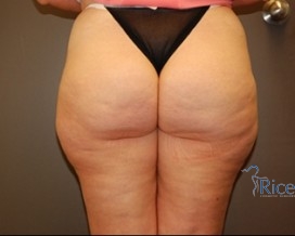 Before-Liposuction