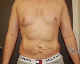 After-Liposuction Stomach