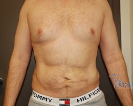 After-Liposuction