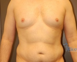 Before-Liposuction Stomach