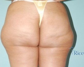 Before-Liposuction