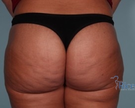 After-Liposuction