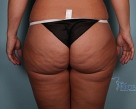 Before-Liposuction