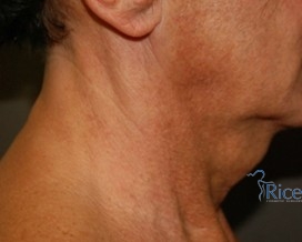 Before-Neck Liposuction