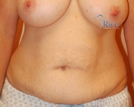 Before-Tummy Tuck