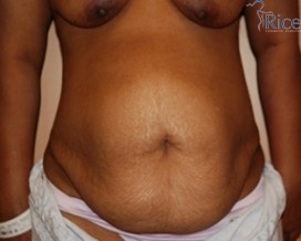 Before-Tummy Tuck