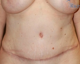 After-Tummy Tuck