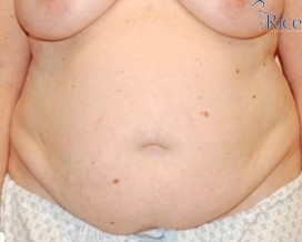 Before-Tummy Tuck