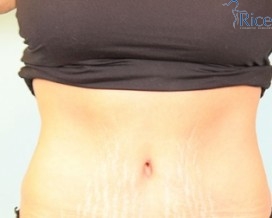 After-Tummy Tuck