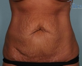 Before-Tummy Tuck