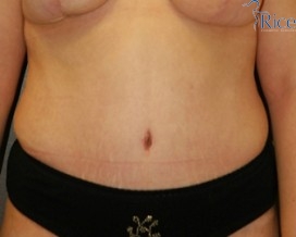 After-Tummy Tuck