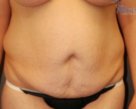 Before-Tummy Tuck