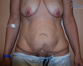 Before-Tummy Tuck