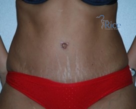 After-Tummy Tuck