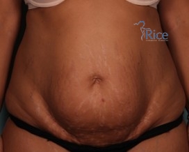 Before-Tummy Tuck