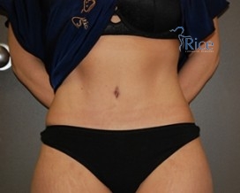 After-Tummy Tuck