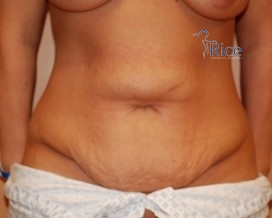 Before-Tummy Tuck