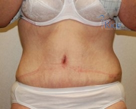 After-Tummy Tuck