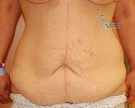 Before-Tummy Tuck