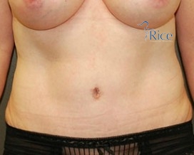 After-Tummy Tuck