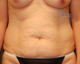 Before-Tummy Tuck