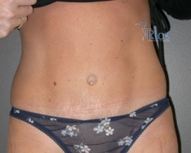 After-Tummy Tuck