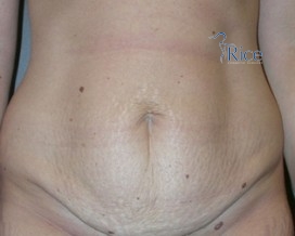 Before-Tummy Tuck