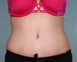 After-Tummy Tuck