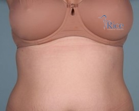 Before-Tummy Tuck