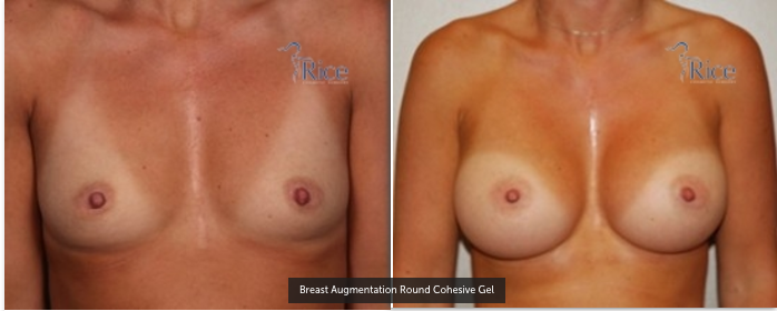 Before and After Breast Augmentation