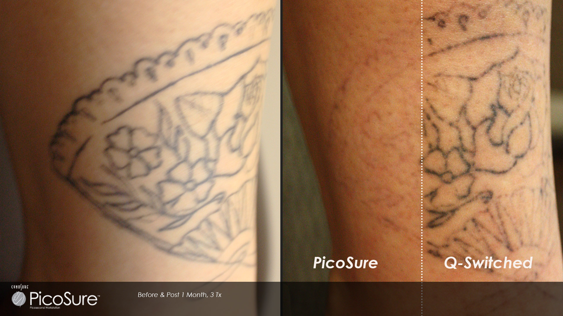 Laser Tattoo Removal Toronto Rice Cosmetic Surgery