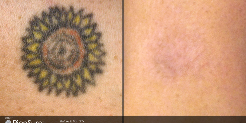 Laser Tattoo Removal Toronto Rice Cosmetic Surgery