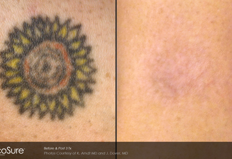 Laser Tattoo Removal Toronto Rice Cosmetic Surgery