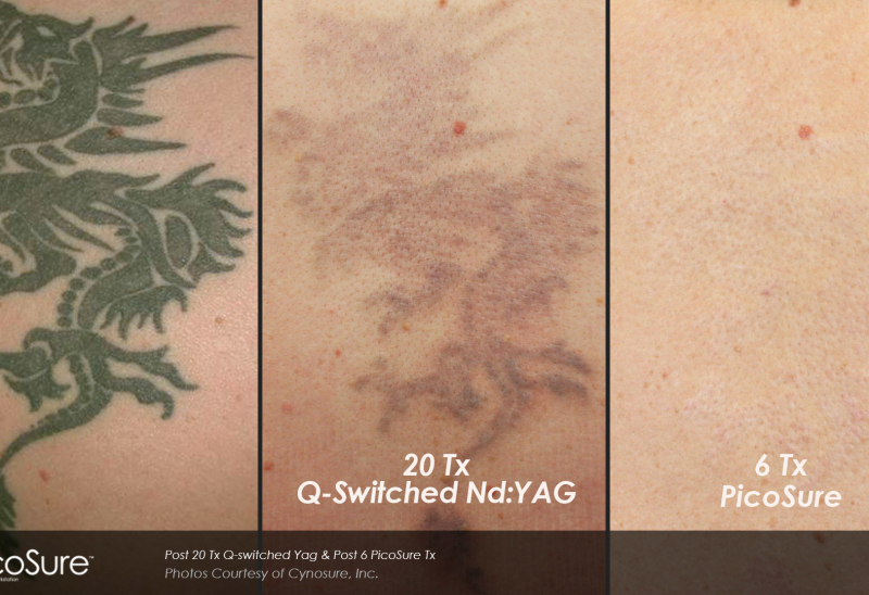 Picosure Laser Tattoo Removal Toronto Rice Cosmetic Surgery