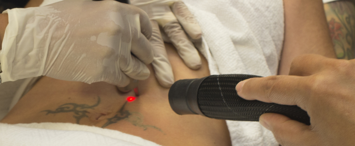 Laser Tattoo Removal Toronto Picosure Rice Cosmetic Surgery