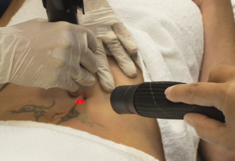 News Talk 1010 – Picosure Tattoo Removal