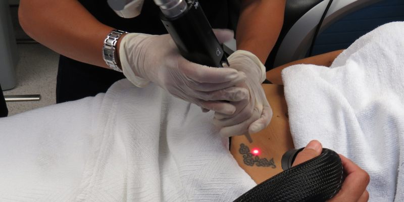 Laser Tattoo Removal Toronto Picosure Rice Cosmetic Surgery