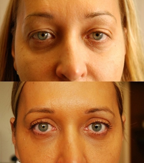 Eyelid Surgery Toronto - Before & After Photo - Rice Cosmetic Surgery
